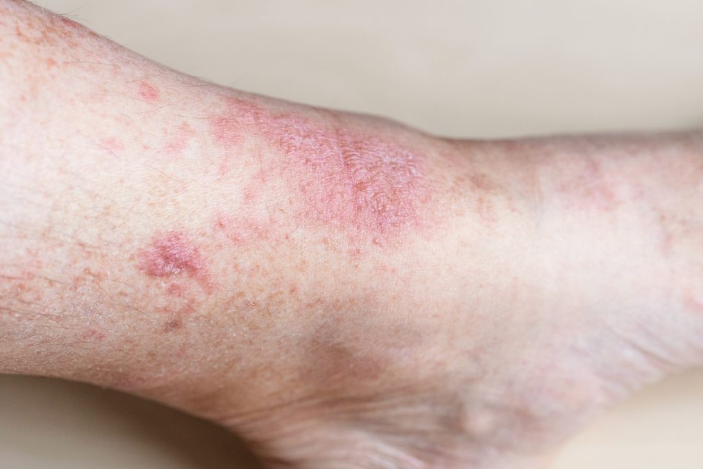 cellulitis bacterial skin infection from alcohol use