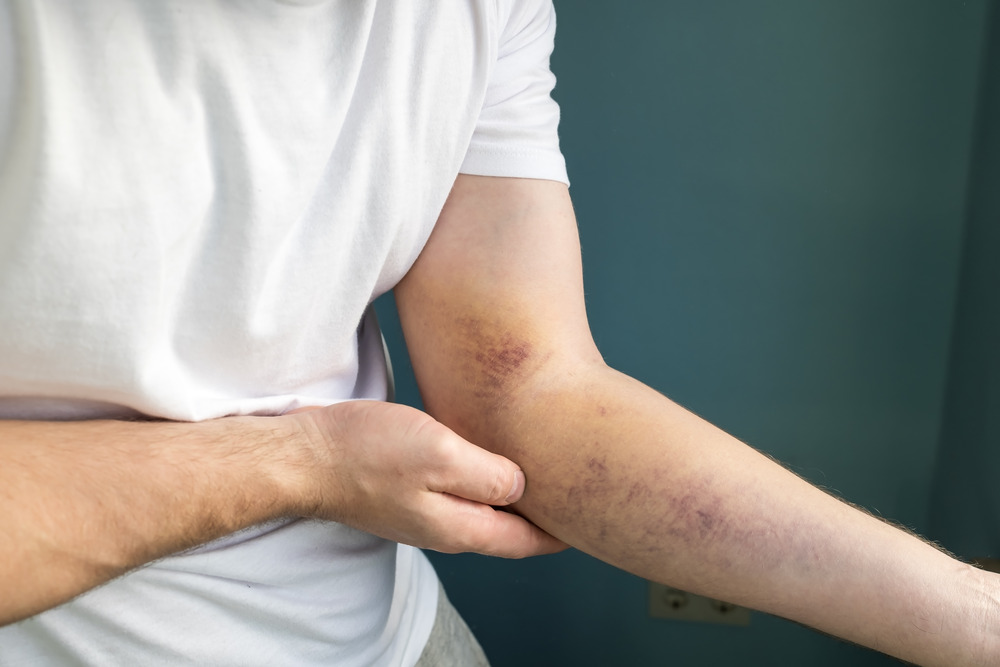 xylazine-related wounds from the zombie drug, the effects of xylazine on the skin